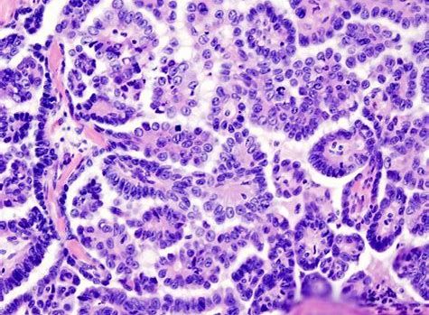 CancerRes：新研究发现帮助清除癌症干细胞的新靶标